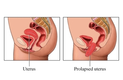 Uterine Prolapse - East Norriton Women's Healthcare